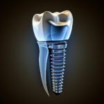 globalsonreir_dental_implant_b34fc102-46e3-4bf5-a1ec-a20905d56344_3.png