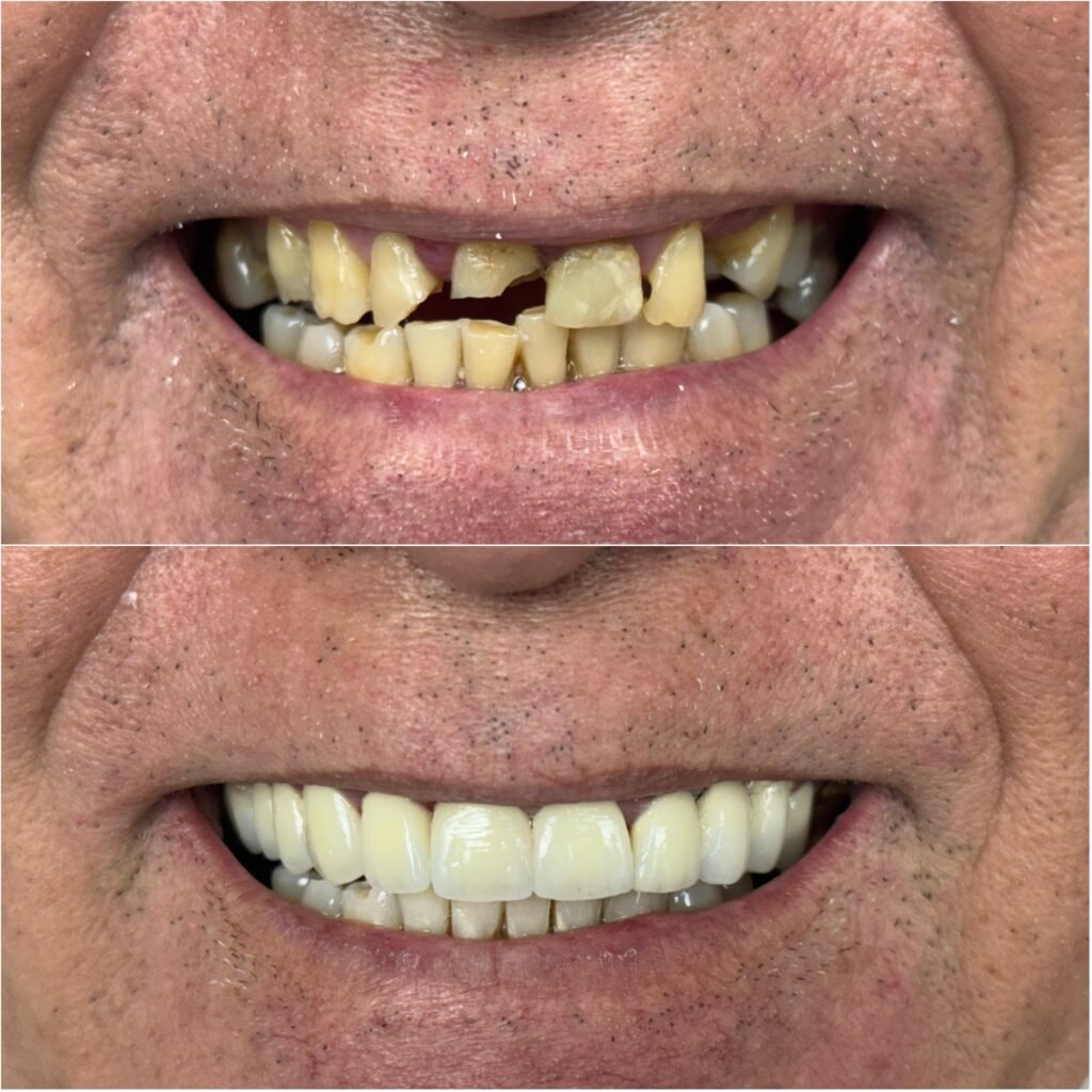 Prt fixa em porcelana