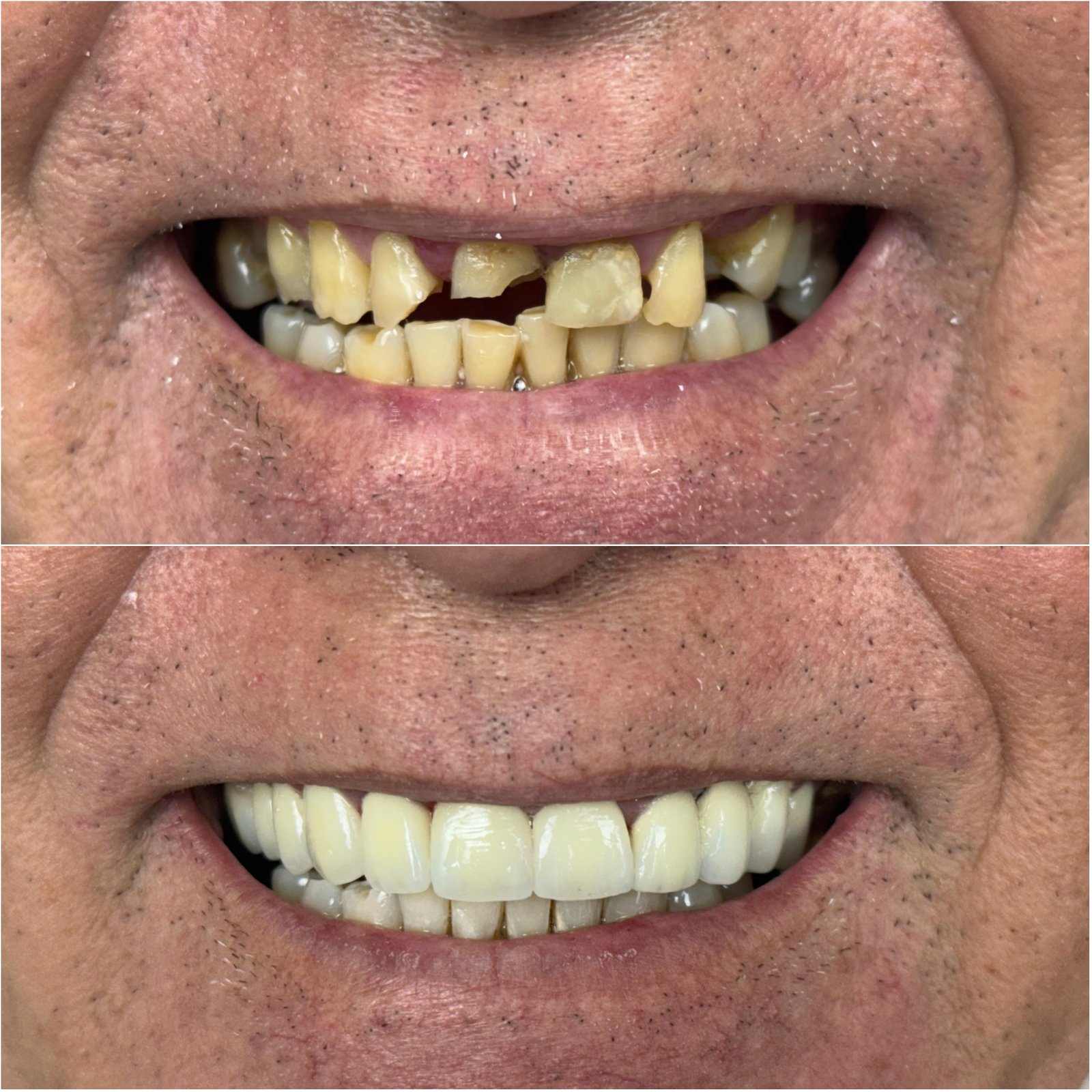 Prt fixa em porcelana